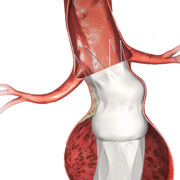 AFX2 ActiveSeal anatomy illustration